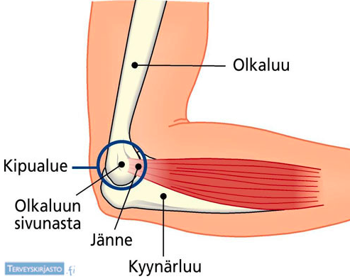 tenniskyynärpään hoito ja oireet